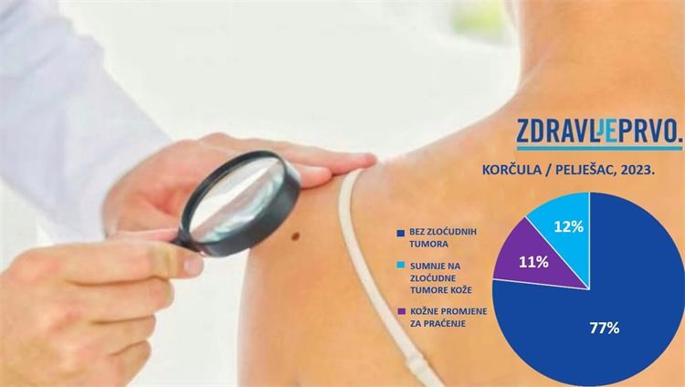 Slika /Vijesti/2023/Rujan/19 rujna/Rano otkrivanje melanoma_Korčula_vizual.jpg